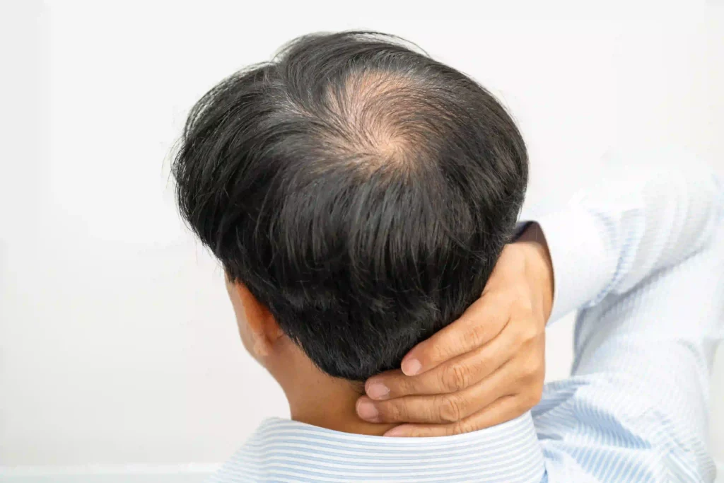 penyebab pitak pada rambut